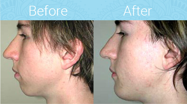 Chin Augmentation Before & After