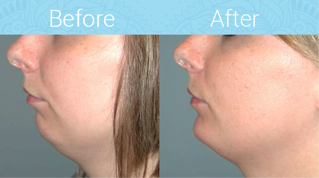 Chin Augmentation Before & After