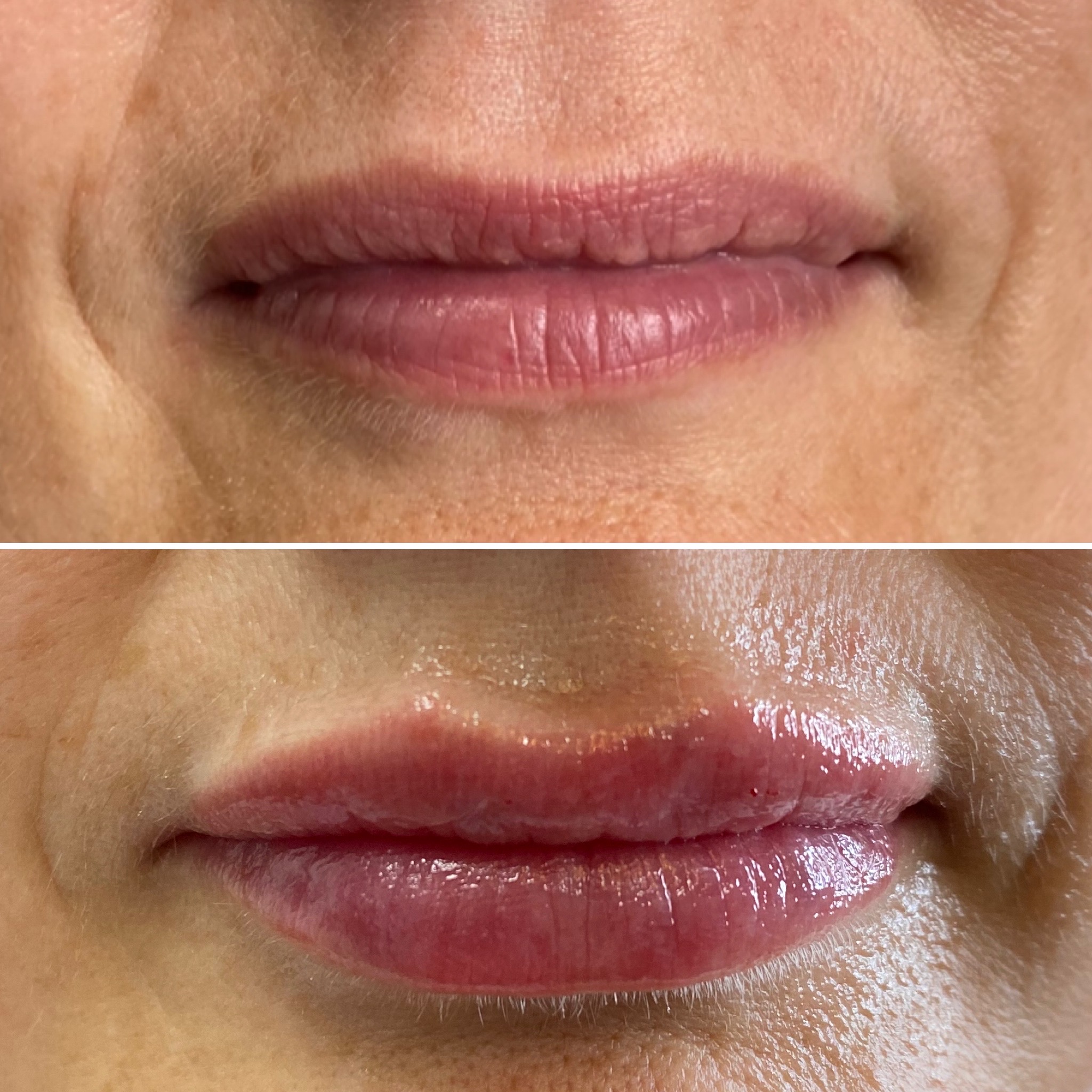 Lip Augmentation