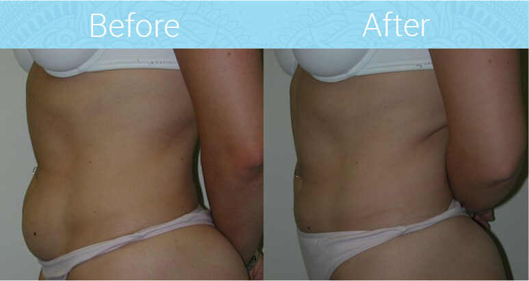 Liposuction Before & After