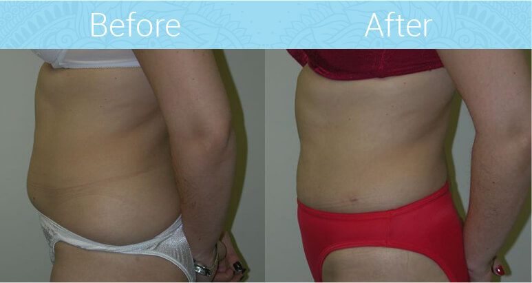 Liposuction Before & After