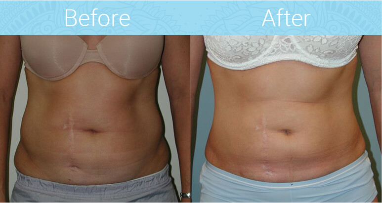 Liposuction Before & After