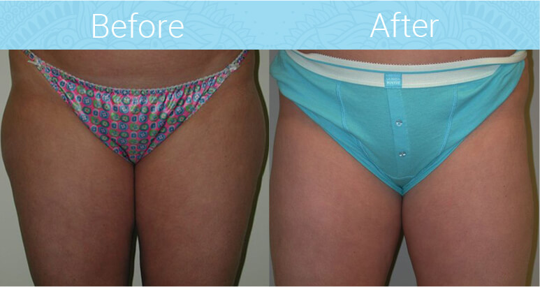 Liposuction Before & After