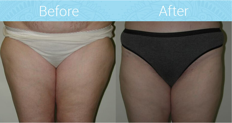 Liposuction Before & After