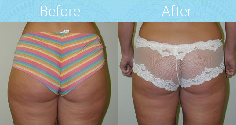 Liposuction Before & After