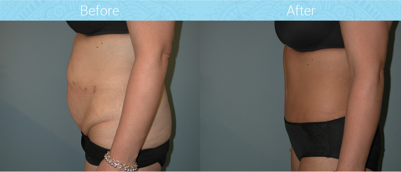 Tummy Tuck Before & After