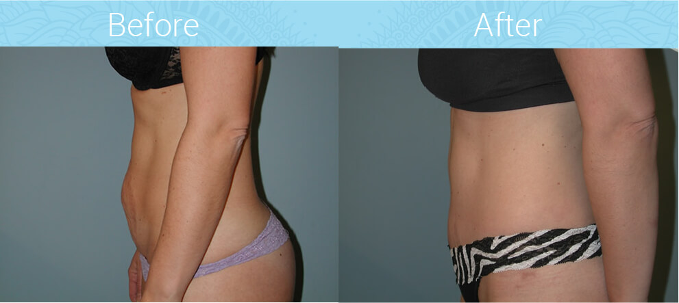 Tummy Tuck Before & After