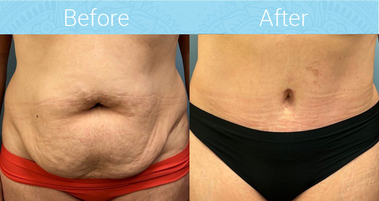 Tummy Tuck Before & After