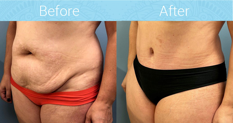 Tummy Tuck Before & After