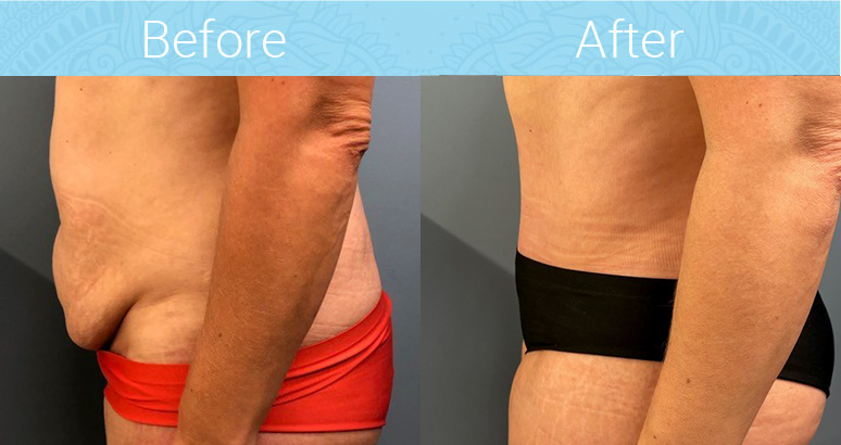 Tummy Tuck Before & After