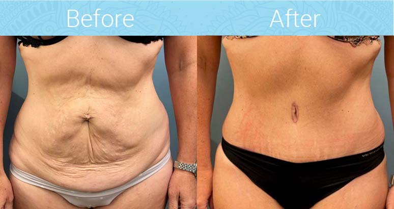 Tummy Tuck Before & After