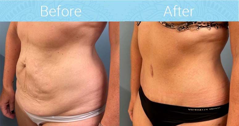 Tummy Tuck Before & After