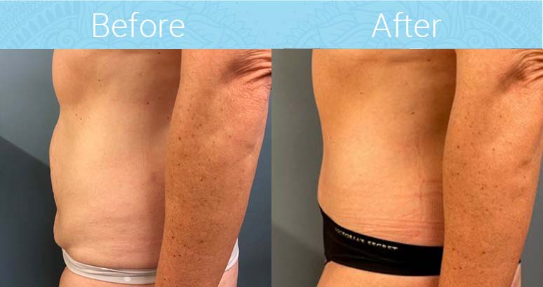 Tummy Tuck Before & After