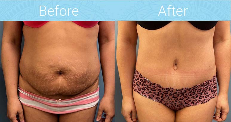 Tummy Tuck Before & After