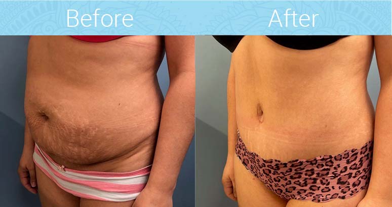 Tummy Tuck Before & After