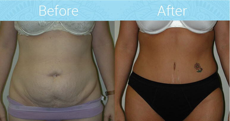 Tummy Tuck Before & After