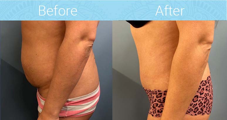 Tummy Tuck Before & After