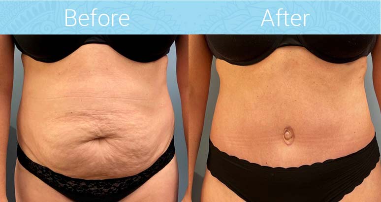 Tummy Tuck Before & After