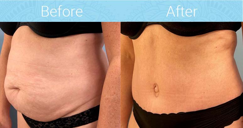 Tummy Tuck Before & After