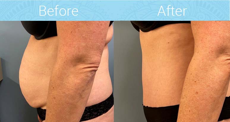 Tummy Tuck Before & After