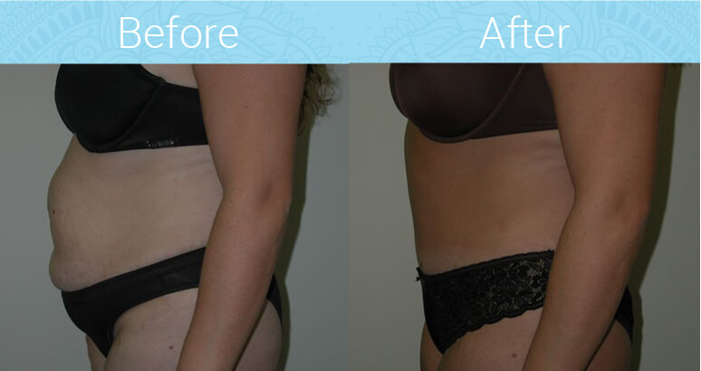 Tummy Tuck Before & After