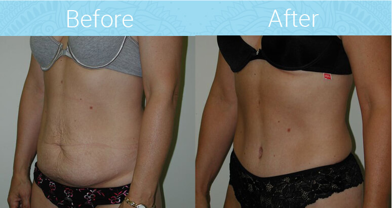 Tummy Tuck Before & After