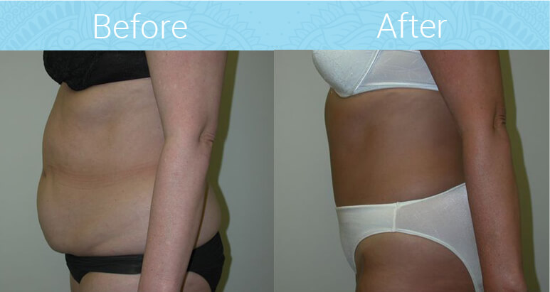 Tummy Tuck Before & After