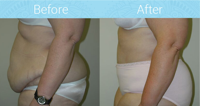 Tummy Tuck Before & After