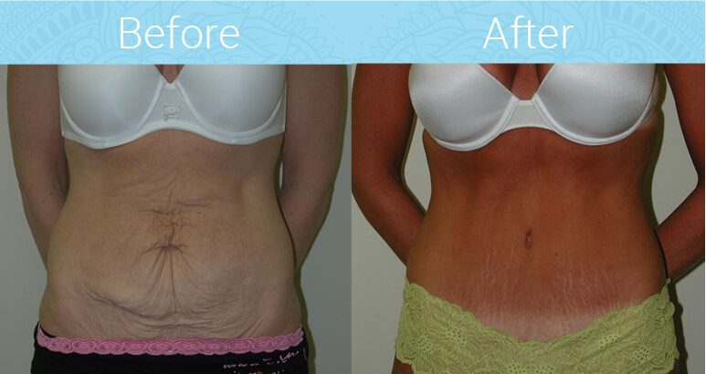 Tummy Tuck Before & After