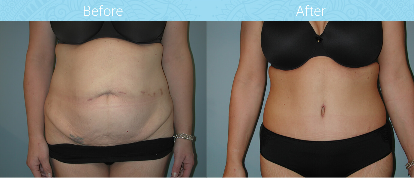 Tummy Tuck Before & After