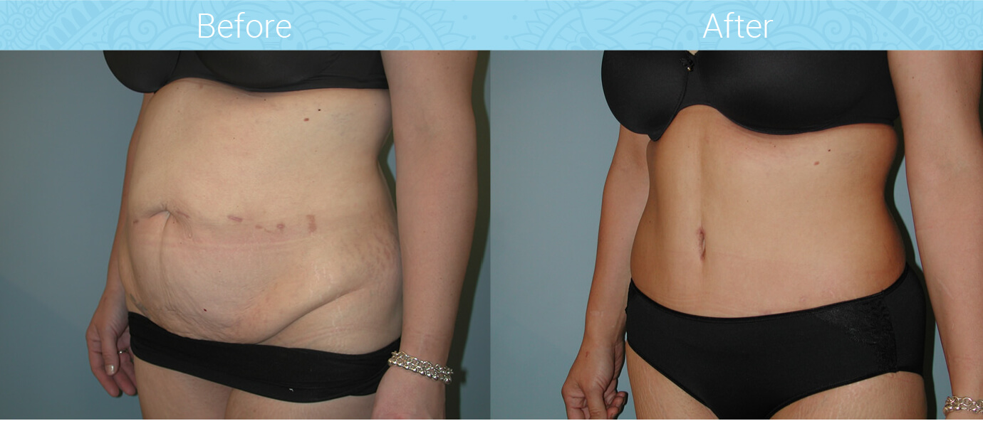 Tummy Tuck Before & After